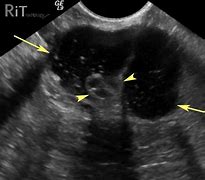 Image result for Brenner Tumor of Ovary Ultrasound
