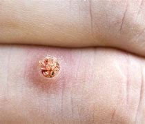 Image result for Wart Root