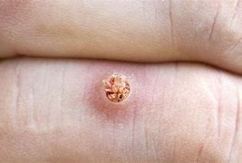 Image result for Plantar Wart Root