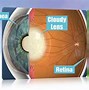 Image result for Cataract Lens Replacement