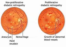 Image result for Classification of Diabetic Retinopathy