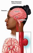 Image result for Brain Stem Aneurysm