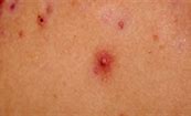 Image result for Lace-Like Rash