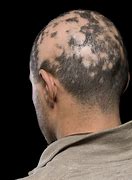 Image result for alopec8a