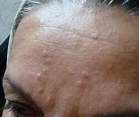Image result for Small Raised Bumps On Forehead