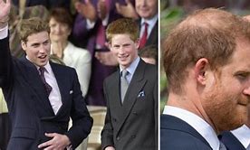 Image result for Prince Harry Hair Before and After