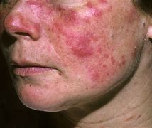 Image result for nokia lupus