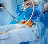Image result for Laparoscopic Surgery