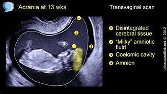 Image result for Acrania in Fetal Ultrasound