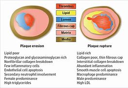 Image result for Acute Coronary Syndrome Plaque Rupture
