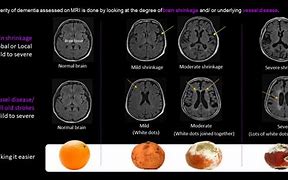Image result for Signs of Shrinking Brain