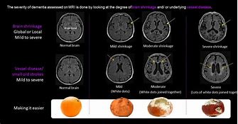 Image result for Shrinking Brain Disease