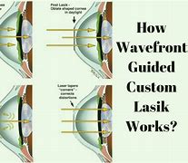 Image result for Custom Lasik Eye Surgery