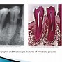 Image result for Gingival and Periodontal Pocket