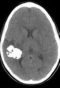 Image result for CT Scan of Oligodendroglioma