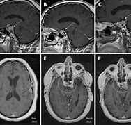 Image result for Pituitary Tumor MRI