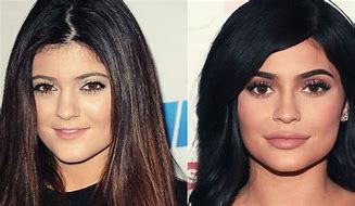 Image result for Kylie Jenner Lip Filler