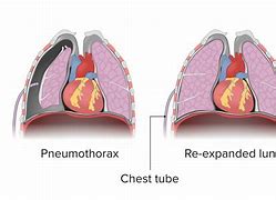 Image result for Pneumothorax Chest Tube
