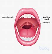 Image result for Strep Throat Rash On Body