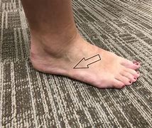 Image result for What Does a Walking Foot Look Like