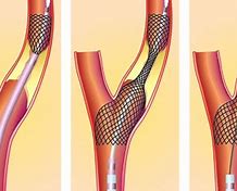 Image result for Surgery for Carotid Stenosis