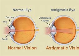 Image result for Inside View of Eye with Astigmatism