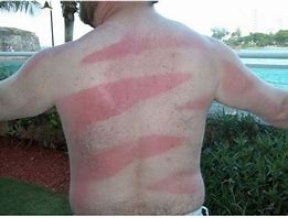 Image result for SunBurn Tattoo