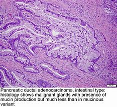 Image result for Pancreas Pathology