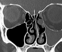 Image result for Maxillary Sinus Endoscopy