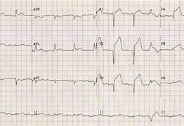 Image result for Old Anterior Infarct ECG