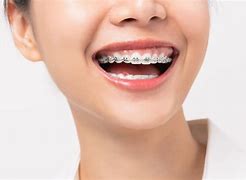 Image result for Braces for Your Teeth