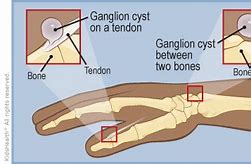 Image result for Ganglion Cyst Tendon