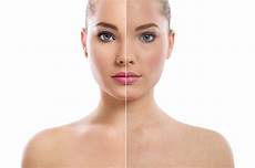 curare l acne dall interno acne giovanile tutto quello c 232 da sapere per curarsi curare l acne dall interno acne giovanile tutto quello c 232 da sapere per curarsi