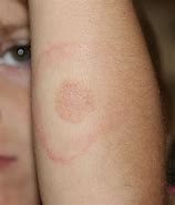 Image result for Childhood Diseases