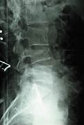 Image result for Lumbar 1 Fracture
