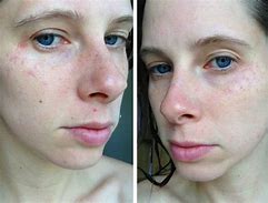 Image result for Sun Poisoning Rash On Chest