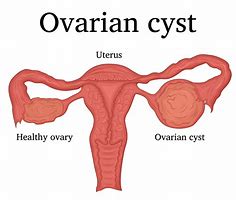Image result for Large Ovary Masses