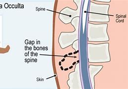 Image result for Hidden Spina Bifida