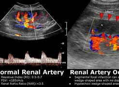 Image result for Renal Artery Stenosis Ultrasound