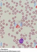 Image result for Atypical Mononuclear Cells