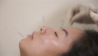 Image result for acupuncturing