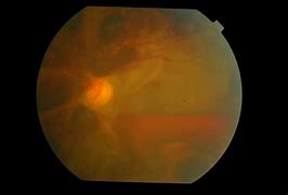 Image result for Anemia Retinopathy