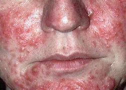 Image result for What Does Rosacea Look Like