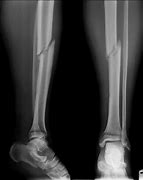 Image result for Motorcycle Accident Broken Arms and Legs