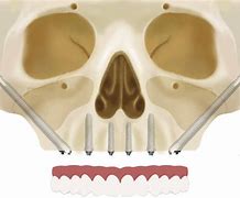 Image result for Zygomatic Dental Implants