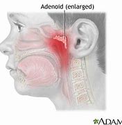 Image result for adenoided