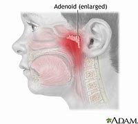 Image result for adenoidds