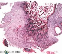 Image result for Best Treatment for Molluscum