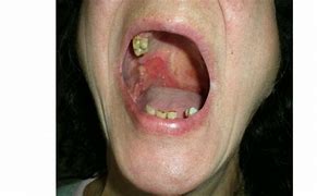 Image result for Squamous Cell Carcinoma Tongue Cancer