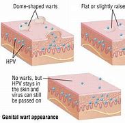 Image result for Genital Warts vs Fordyce Spots